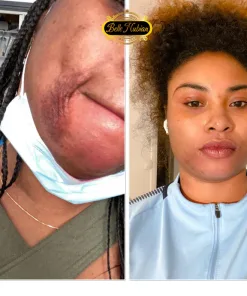 Des photos côte à côte montrent le visage d'une femme avant et après le traitement ; l'image de gauche présente une cicatrice faciale, tandis que l'image de droite montre une peau améliorée après l'utilisation de GLUTA BIO ULTIME (2000mg).