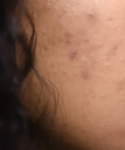 Solutions contre l'acné et coups de soleil