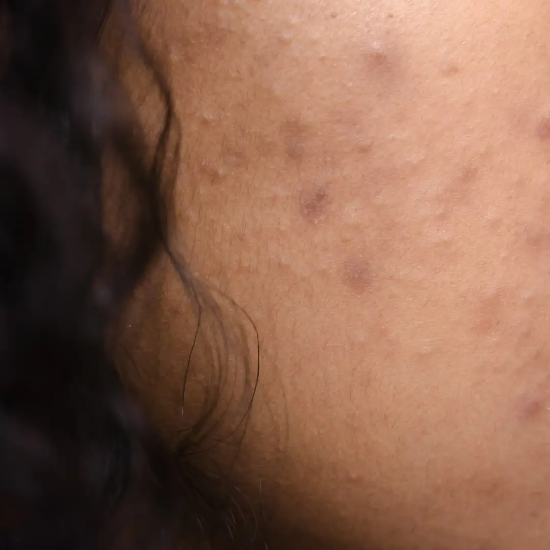 Solutions contre l'acné et coups de soleil