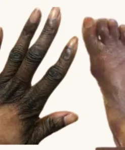 Mains et pieds noirs