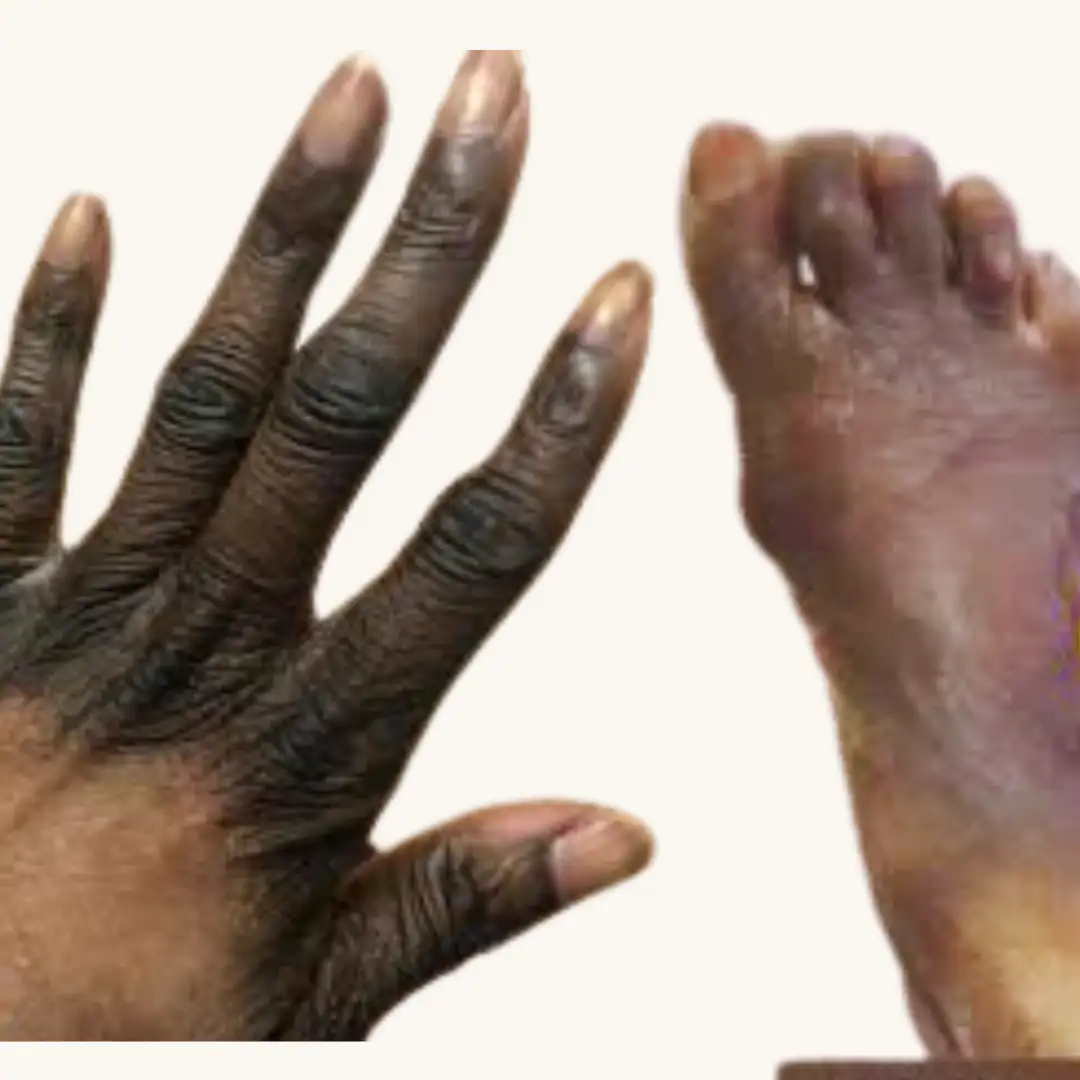 Mains et pieds noirs