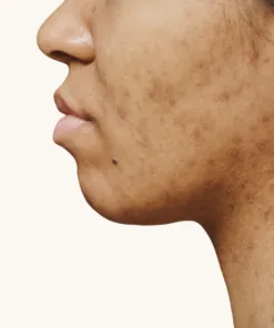 Anti-taches & hyperpigmentation
