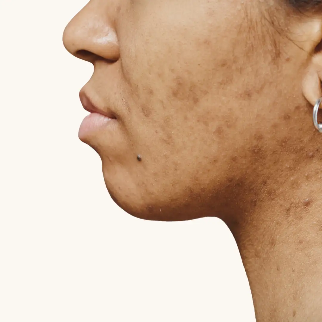 Anti-taches & hyperpigmentation
